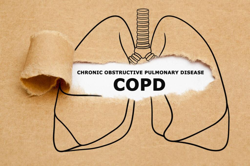 Using CBD Oils For COPD Treatment - Benefits, Dosage, & Safety - Vimarsana News