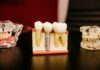 Dental Implants Vs. Dental Bridges: How To Decide Which Tooth Replacement Is Right For You