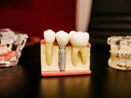 Dental Implants Vs. Dental Bridges: How To Decide Which Tooth Replacement Is Right For You