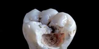 Smart Options For Addressing A Cracked Tooth Comfortably